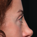 Blepharoplasty and Brow Lift Before & After Patient #34363